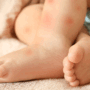 Huiduitslag bij je baby - Check de rode vlekkenwijzer