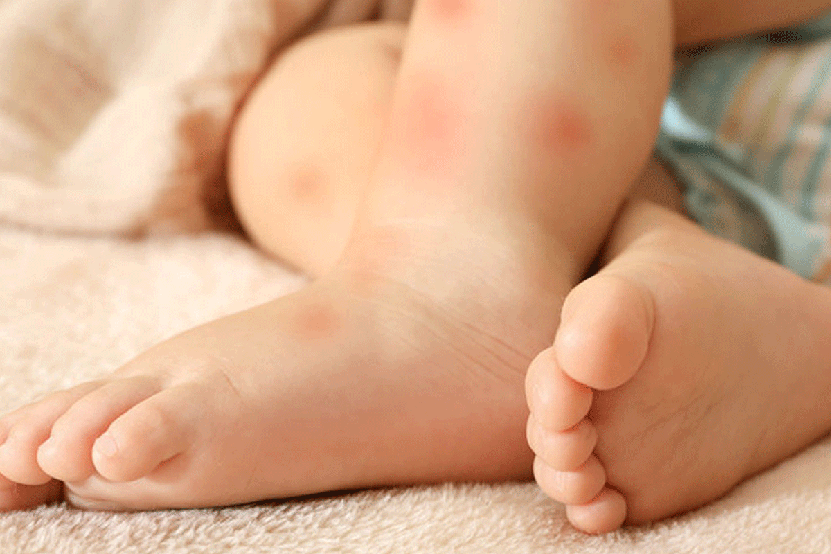 Huiduitslag bij je baby - Check de rode vlekkenwijzer