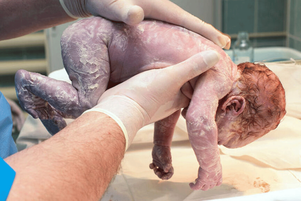 Asfyxie: Zuurstoftekort bij je baby